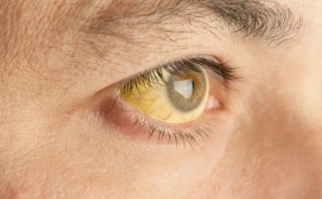 Pourquoi une jaunisse doit toujours alerter et conduire à vérifier la santé du foie ? Pourquoi une jaunisse doit toujours alerter et conduire à vérifier la sante du foie