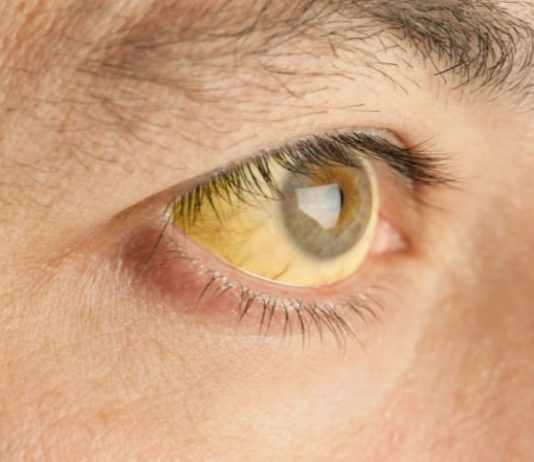 Pourquoi une jaunisse doit toujours alerter et conduire à vérifier la santé du foie ? Pourquoi une jaunisse doit toujours alerter et conduire à vérifier la sante du foie